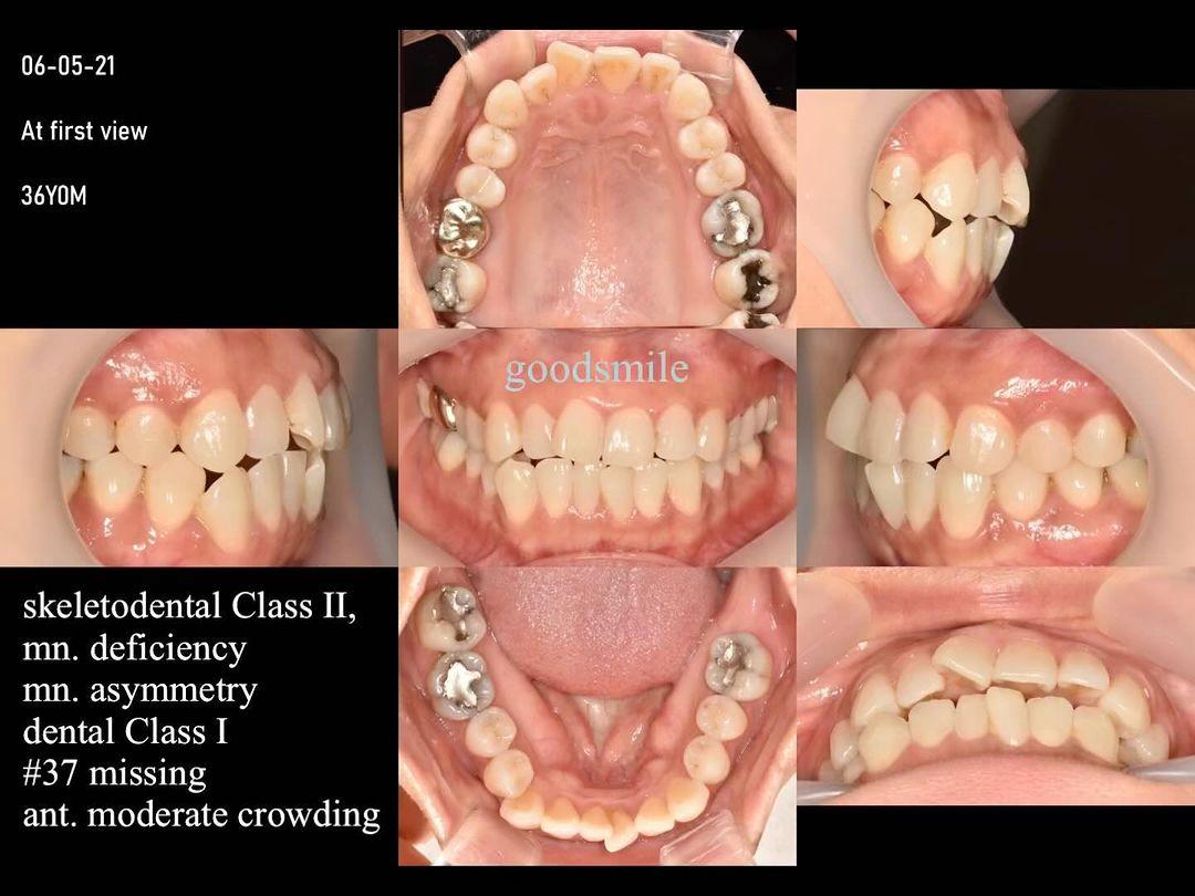 Camouflage treatment of skeletodental Class II, de…