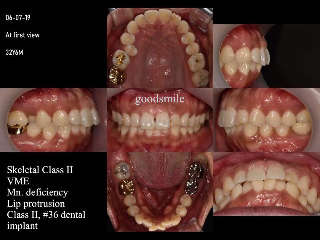 Treatment of skeletodental Class II, dental Class …