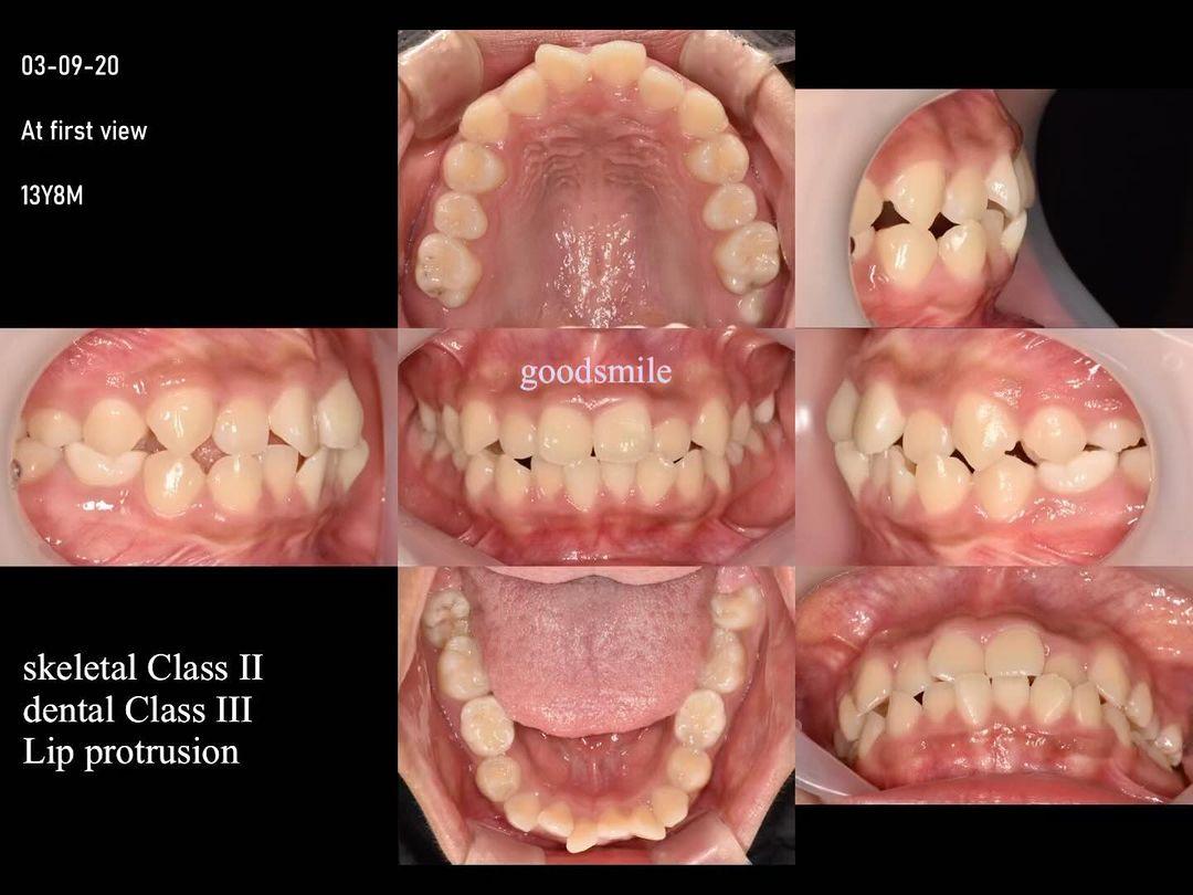 Treatment of skeletal Class II, dental Class III w…