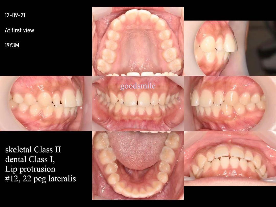 Treatment of slight lip protrusion with total arch…