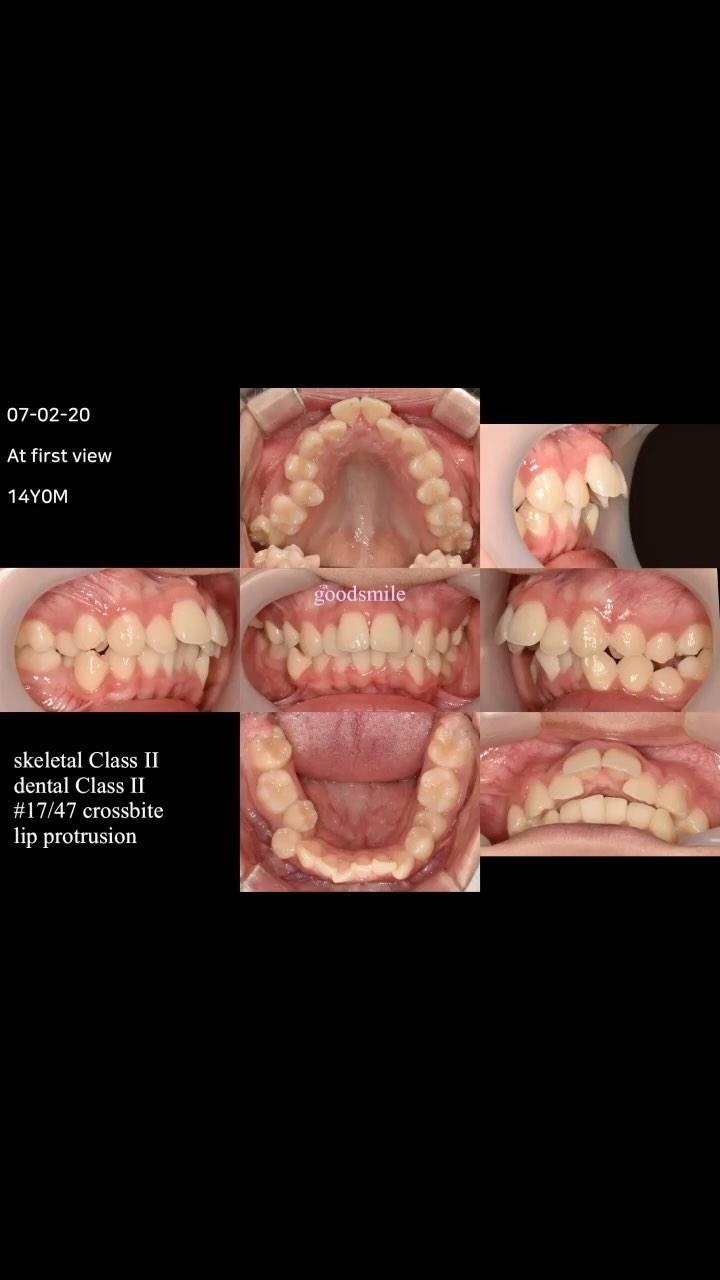 Camouflage treatment of skeletal Class II, dental …
