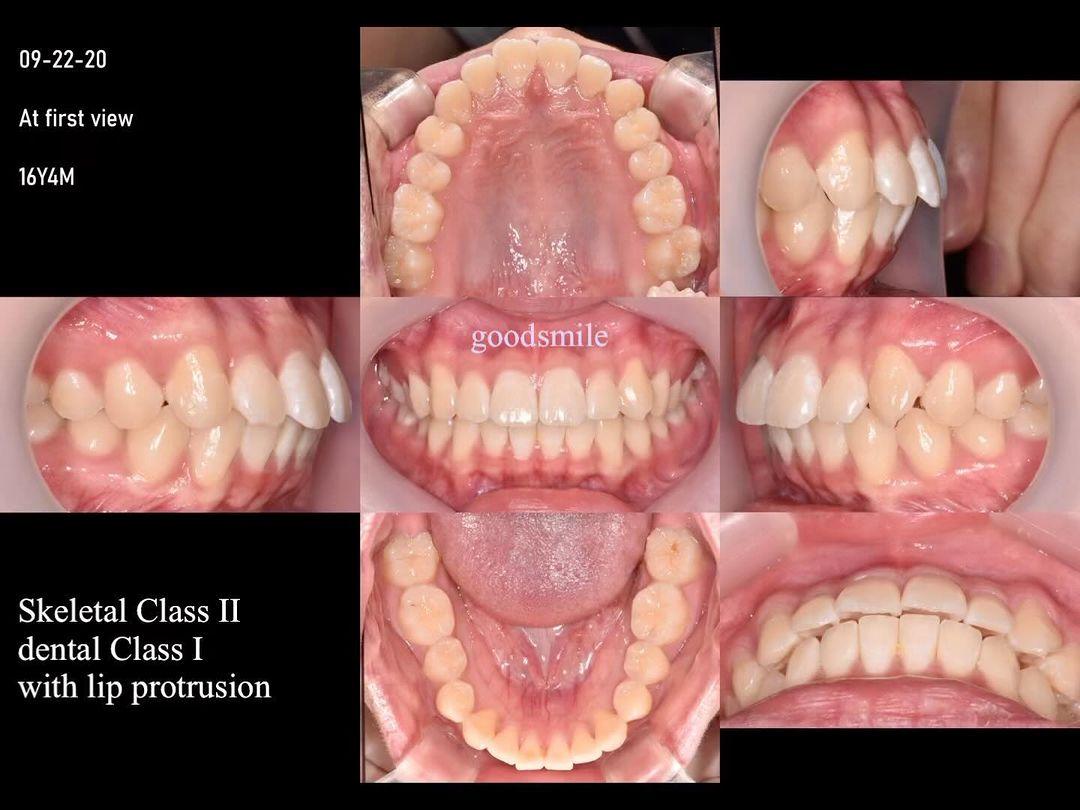 Treatment of bimaxillary protrusion
slight Class I…