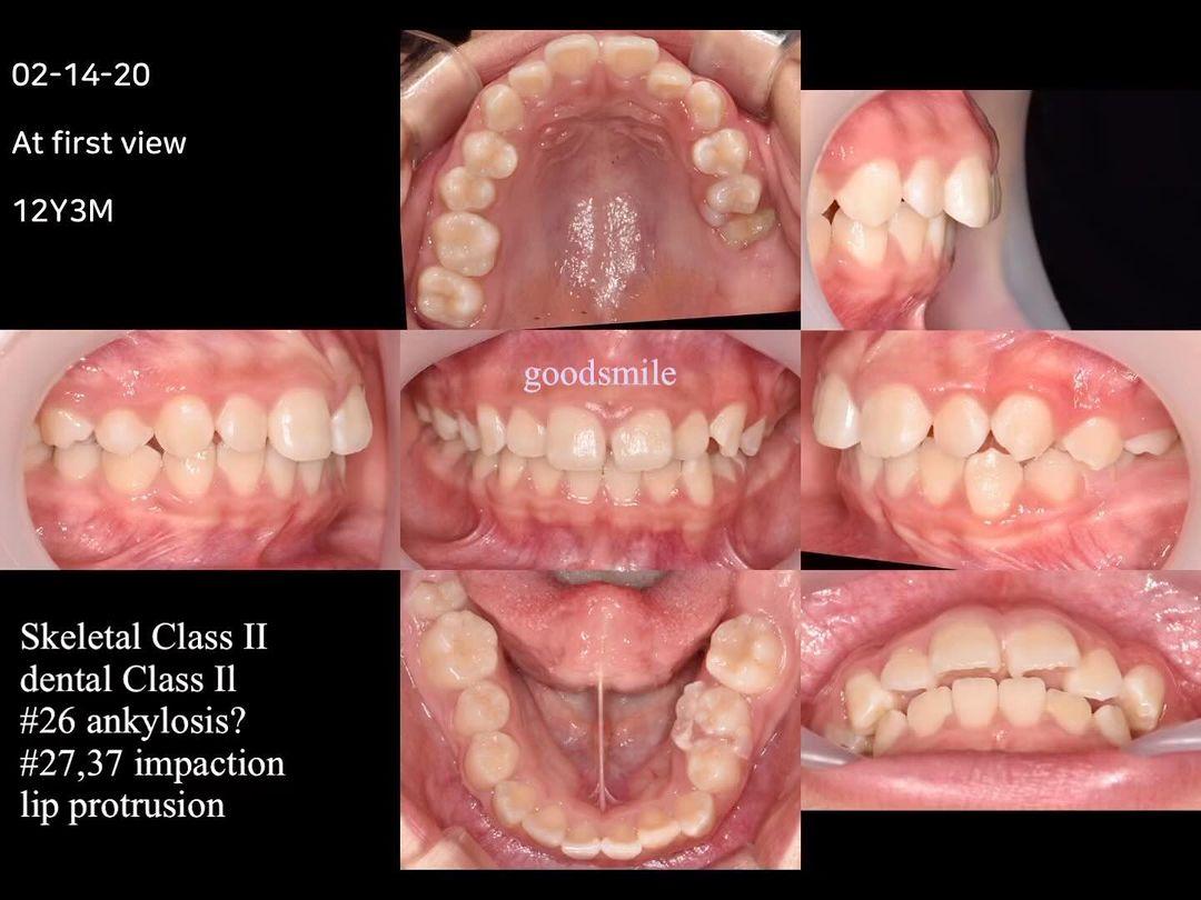 Treatment of skeletal Class II, dental Class II wi…