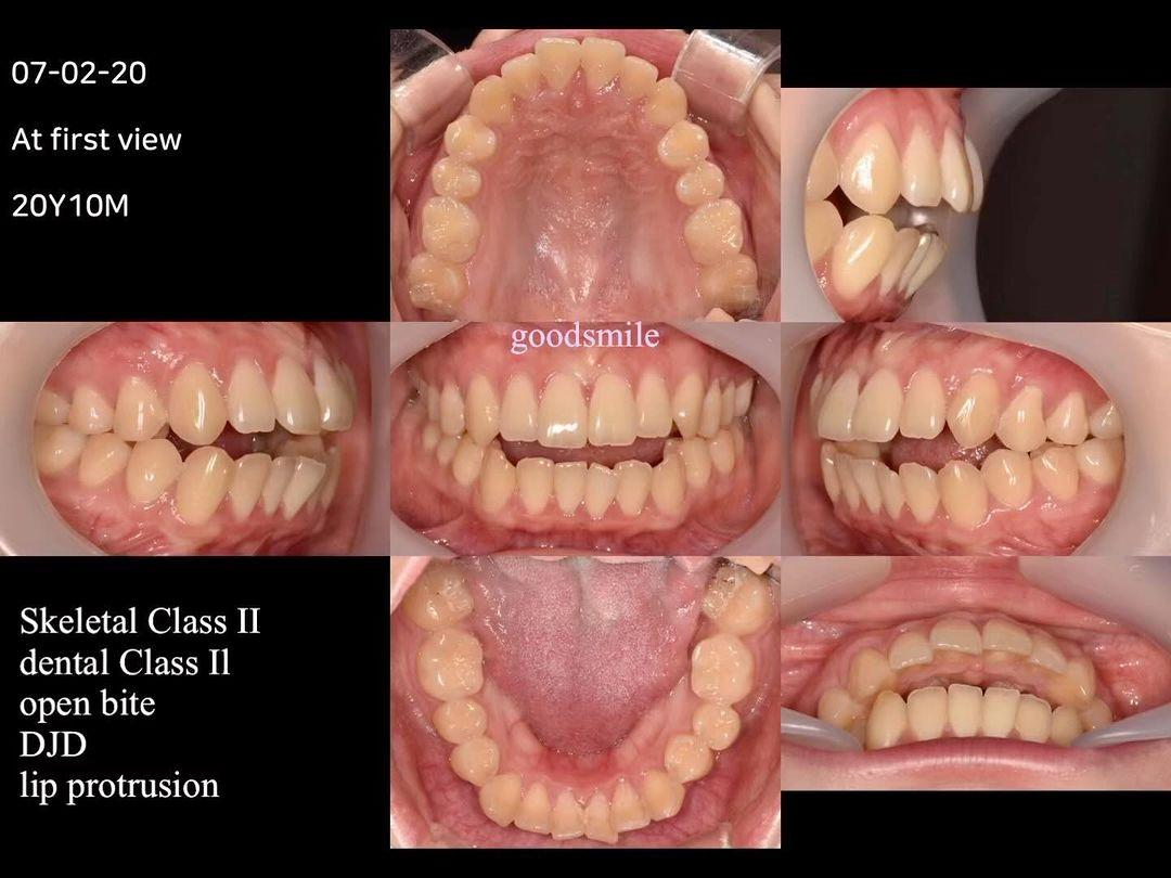 Treatment of skeletal Class II with DJD, openbite …
