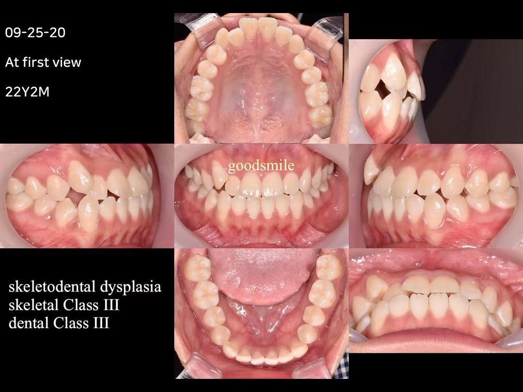 Treatment of skeletal Class III, dental Class III …