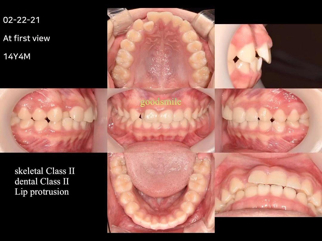Treatment of skeletodental dysplasia, skeletal Cla…