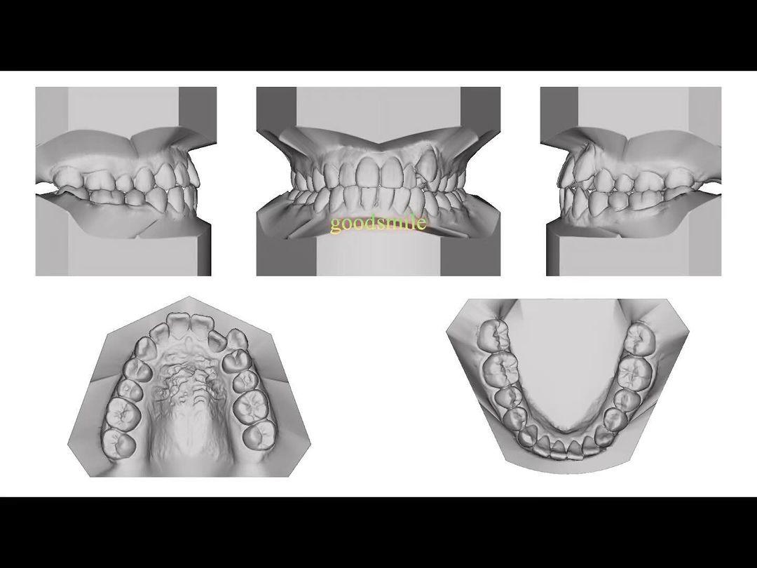 treatment of skeletal Class III, dental Class III,…