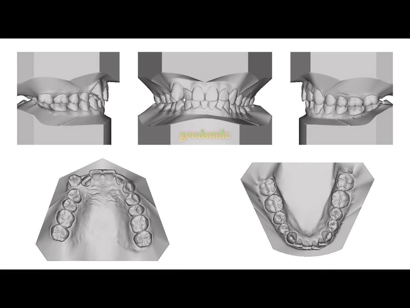 Treatment of skeletal Class II, dental Class II wi…