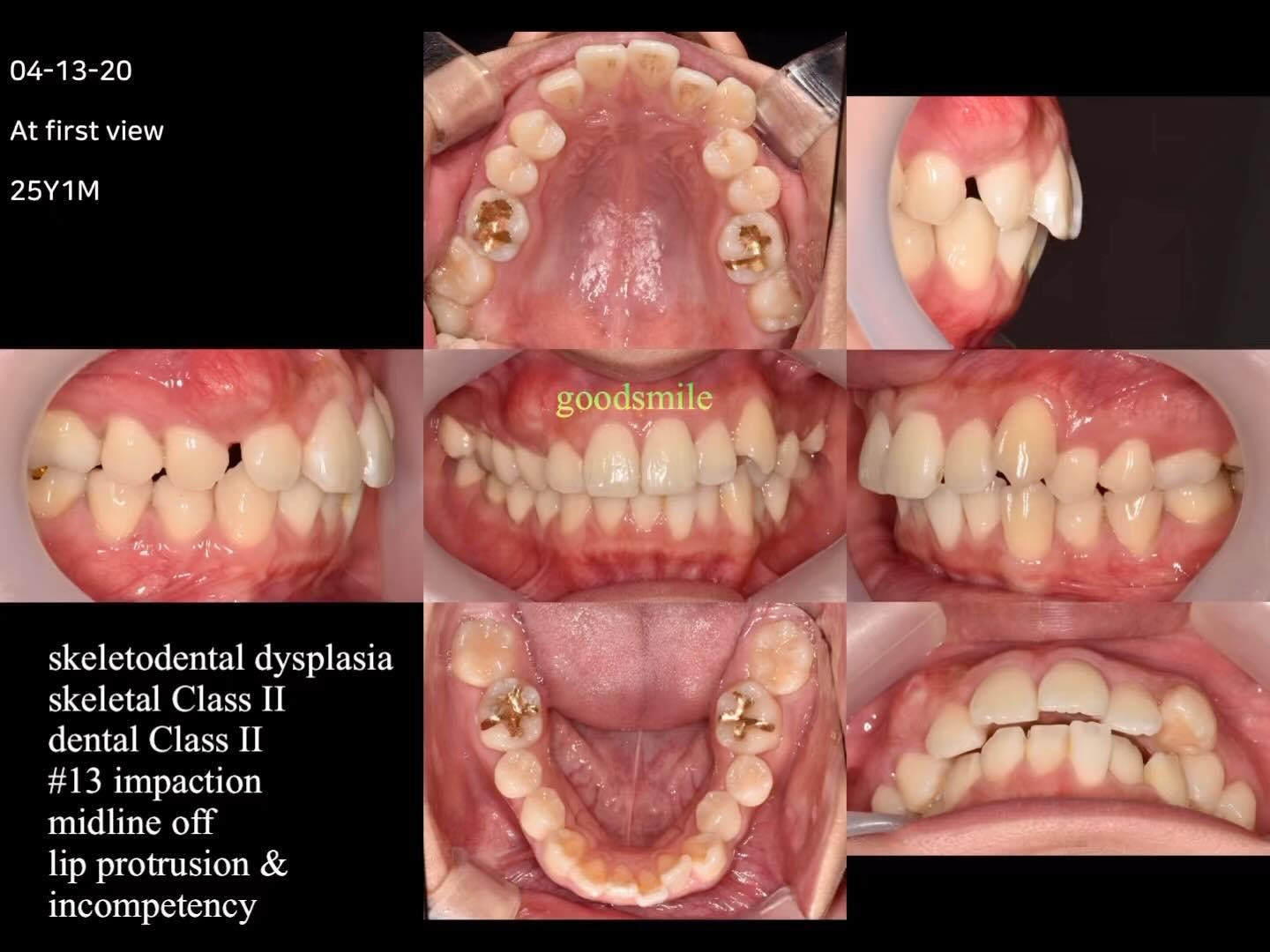 Treatment of skeletodental Class II with impacted …