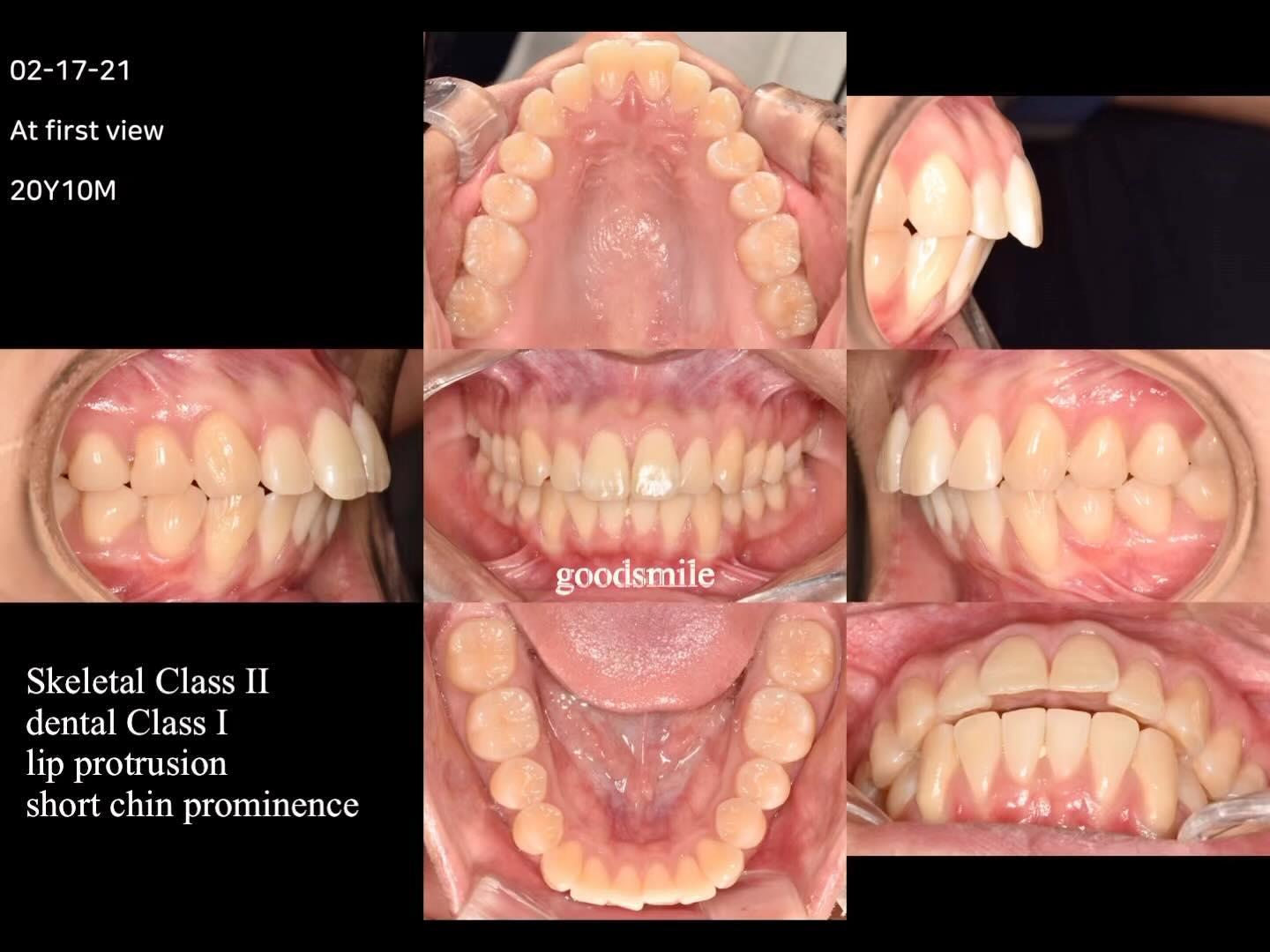 Treatment of skeletal Class II, dental Class I wit…