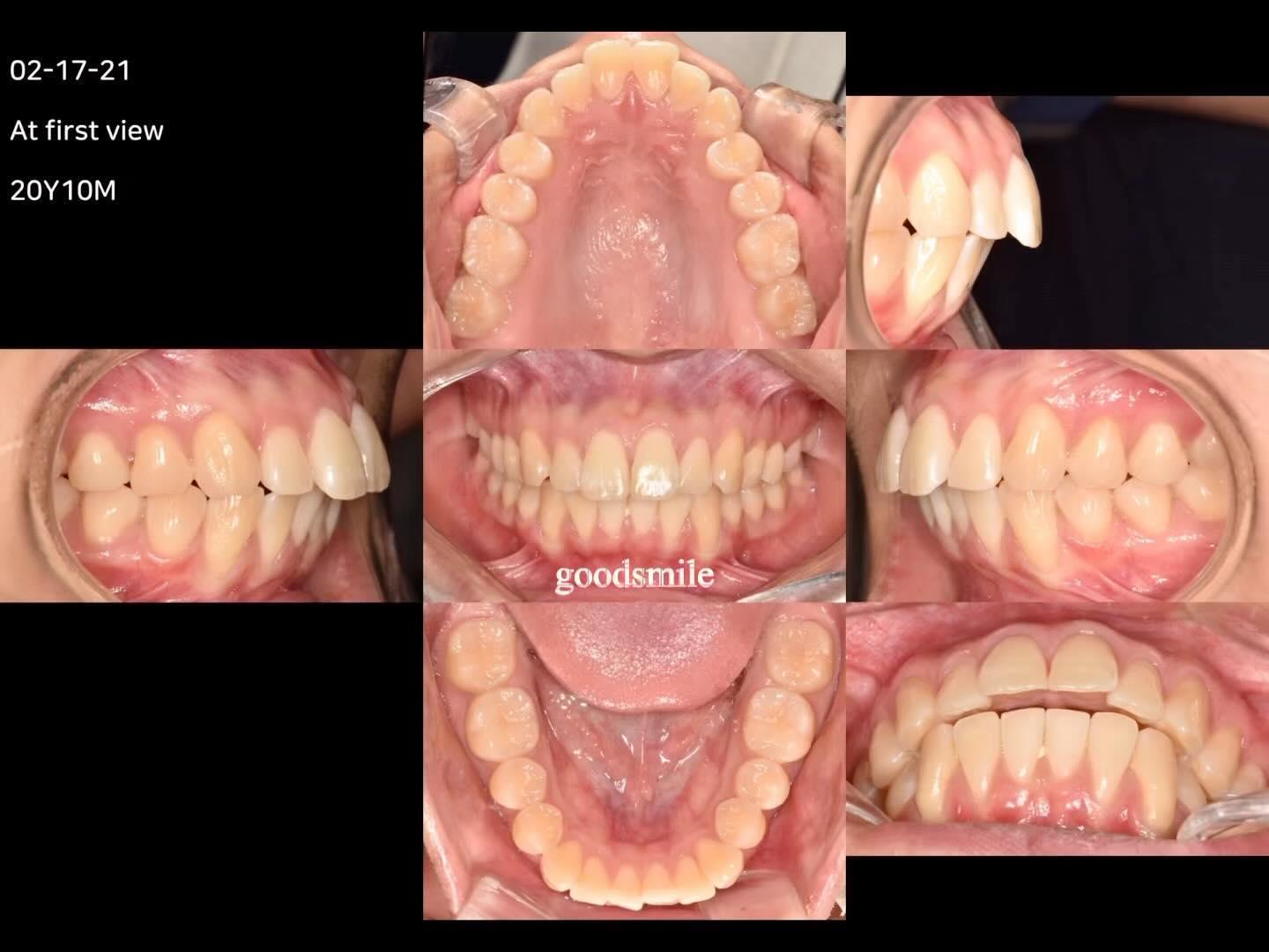Camouflage treatment of skeletal Class II
dental …