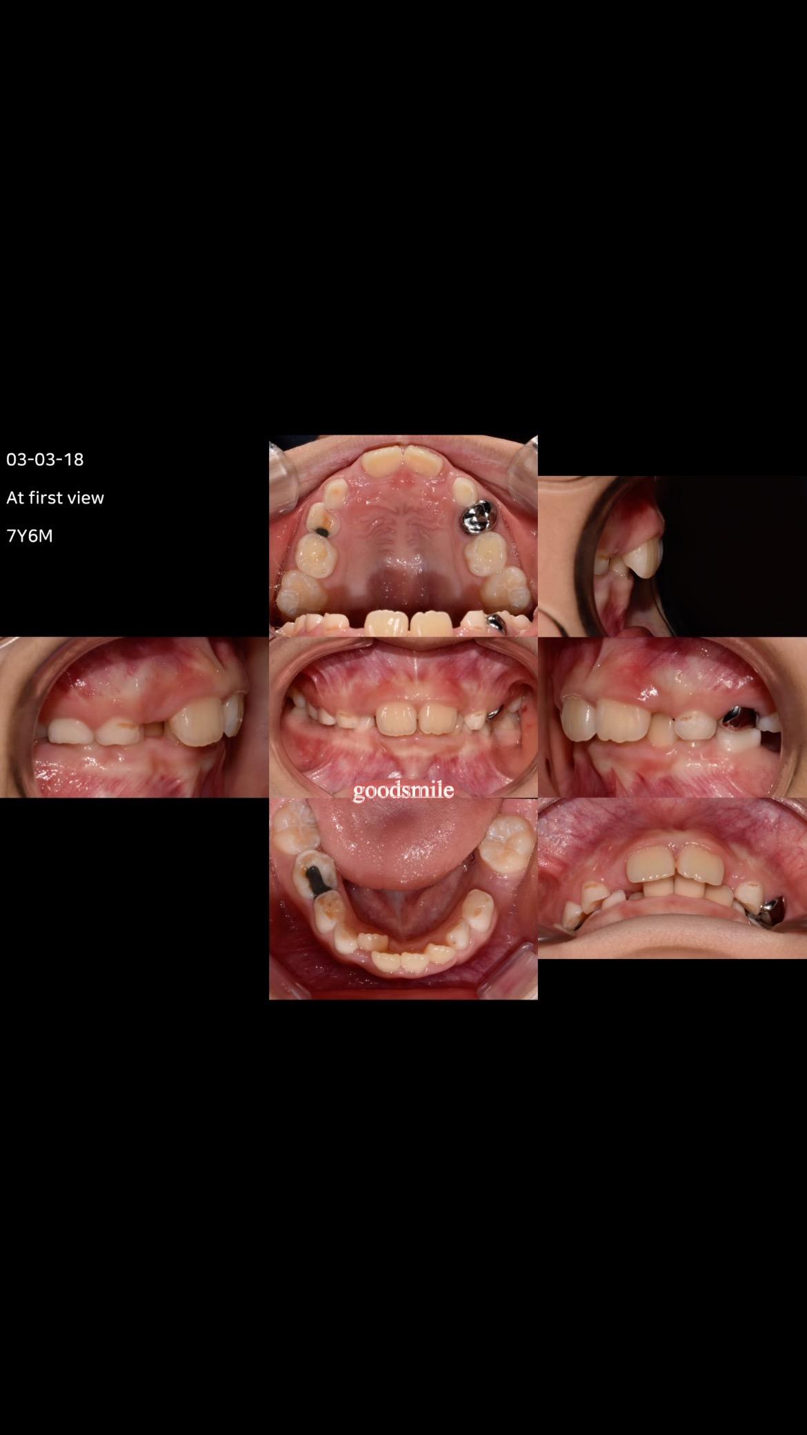 Phase II treatment of skeletal Class II with forwa…