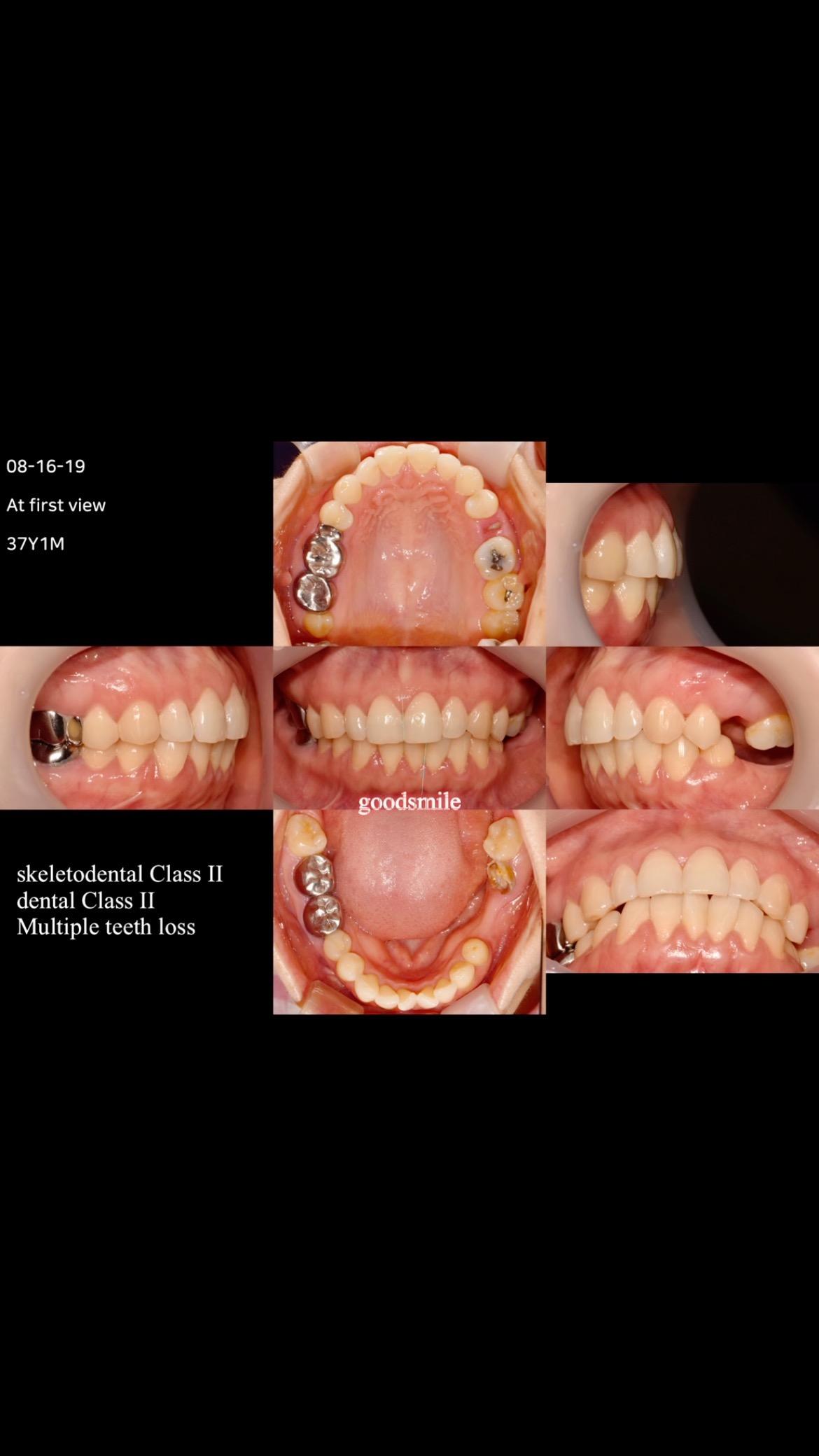 Camouflage treatment of skeletodental Class II, de…