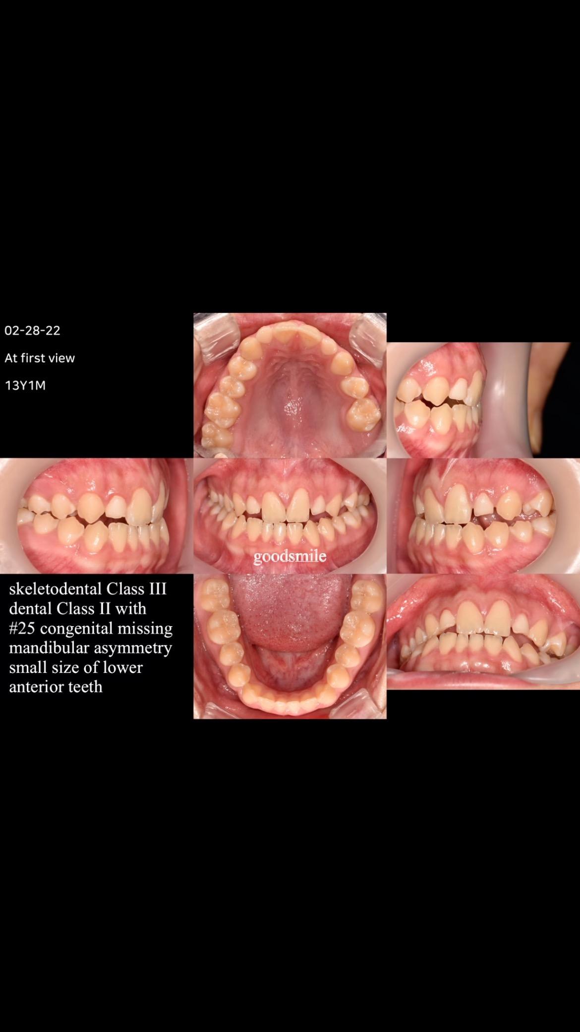 Camouflage treatment of skeletodental Class III, m…