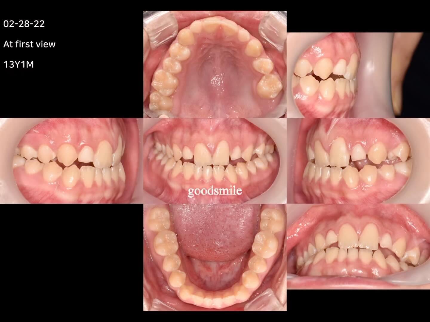 Multidisciplinary treatment of skeletodental Class…