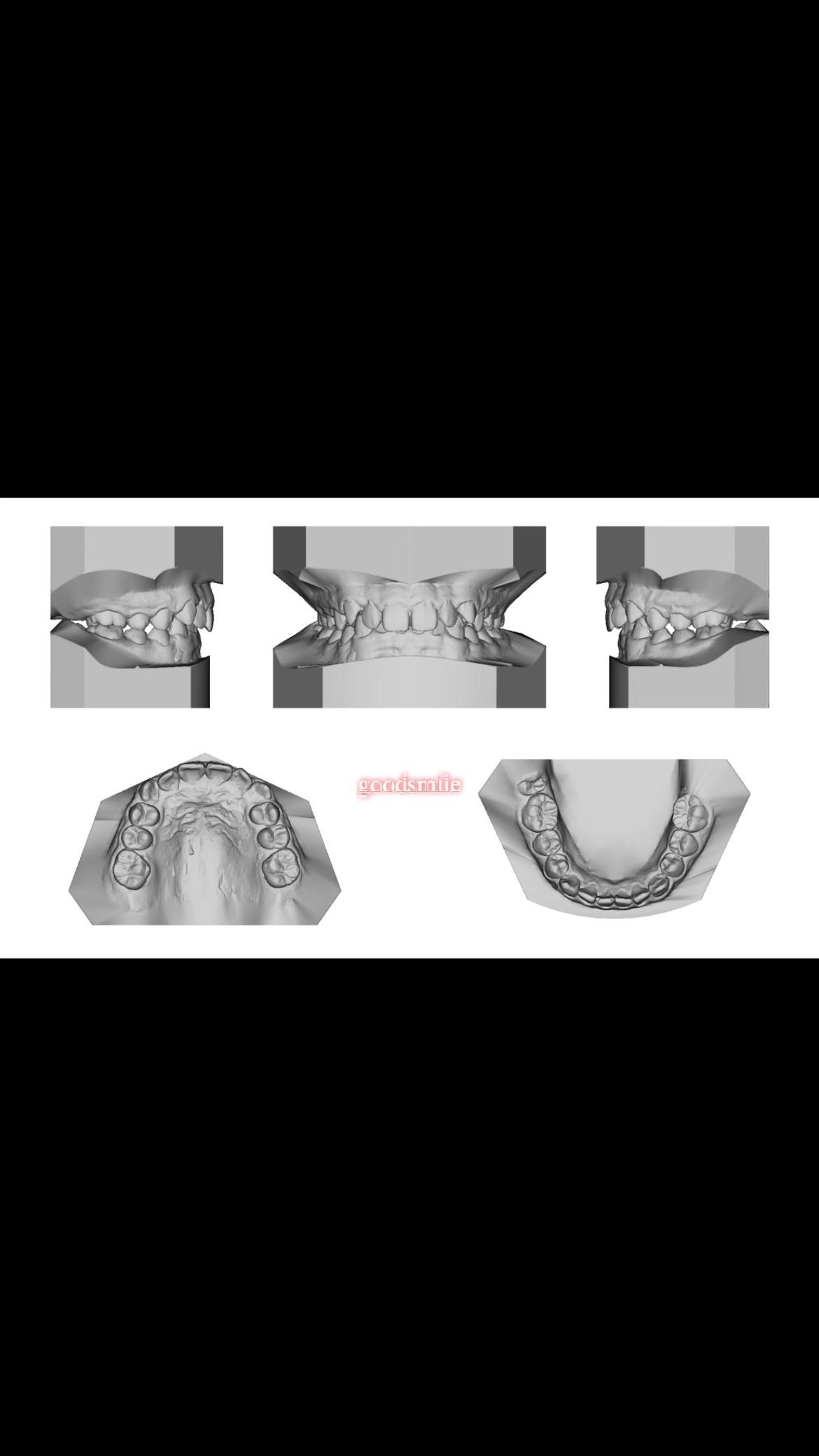 reatment of skeletodental Class II, dental Class I…