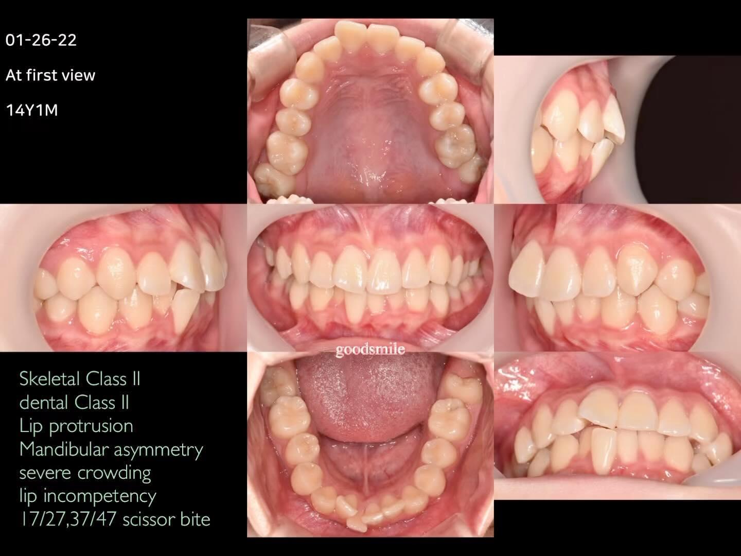 Camouflage treatment of skeletodental Class II wit…