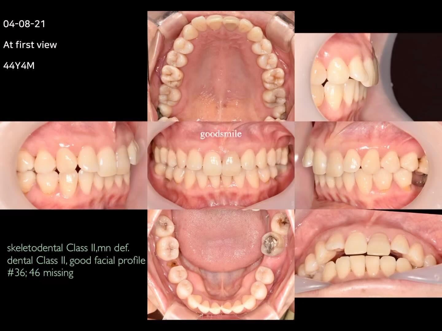 Molar protraction case for Class II molar relation…