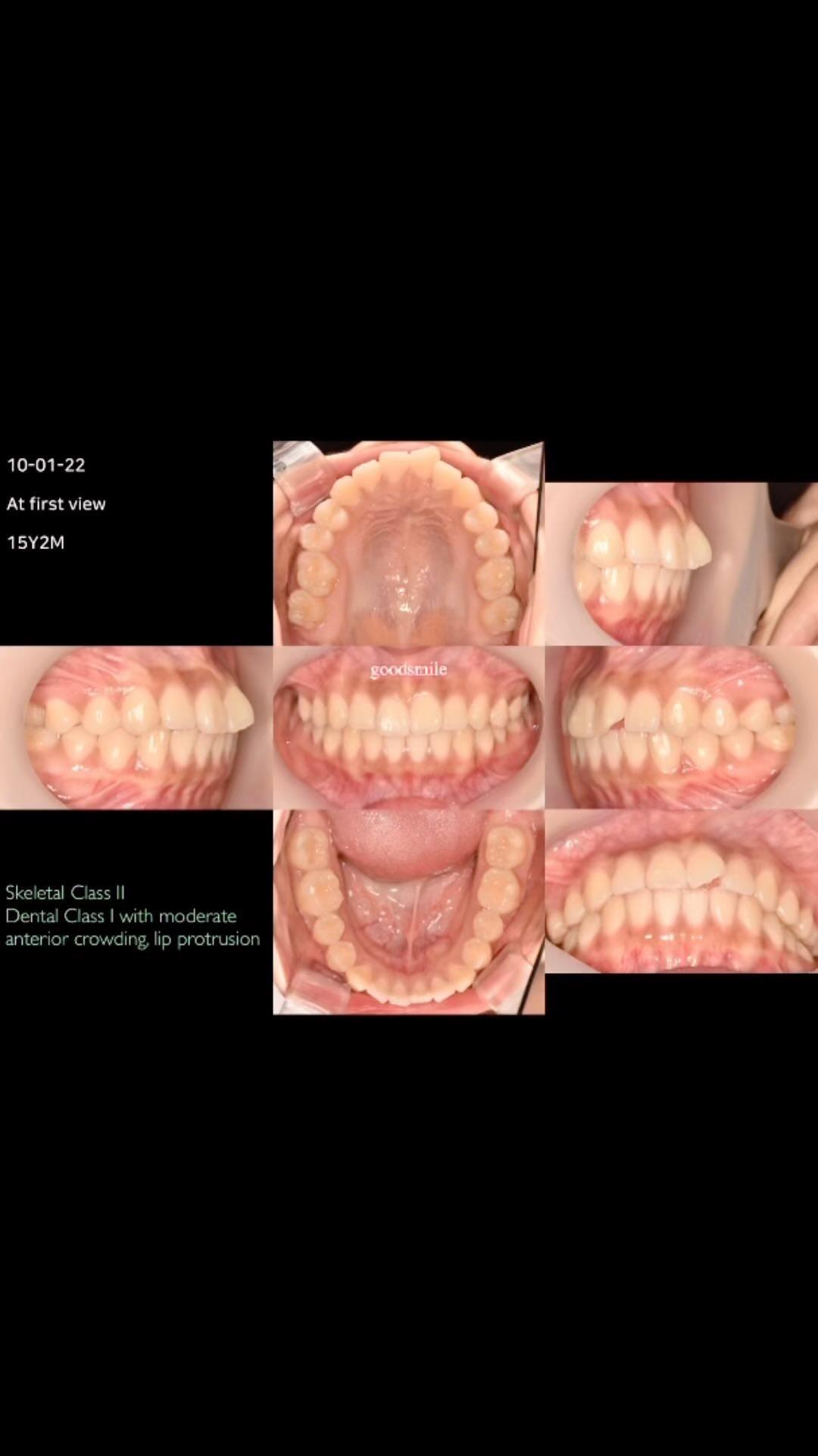 Treatment of dental Class I with moderate lip prot…