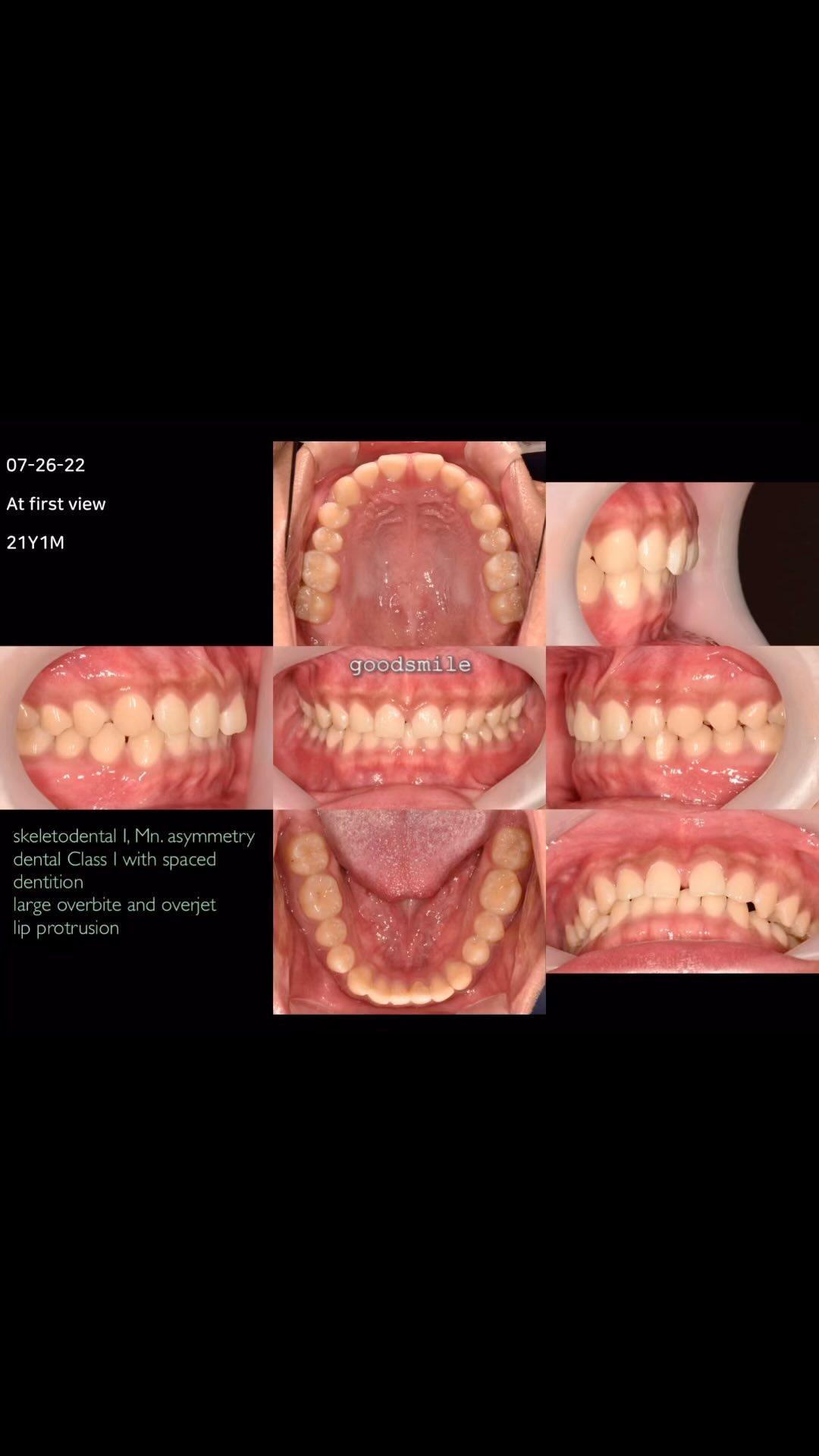 Treatment of dental Class I with spaced dentition …