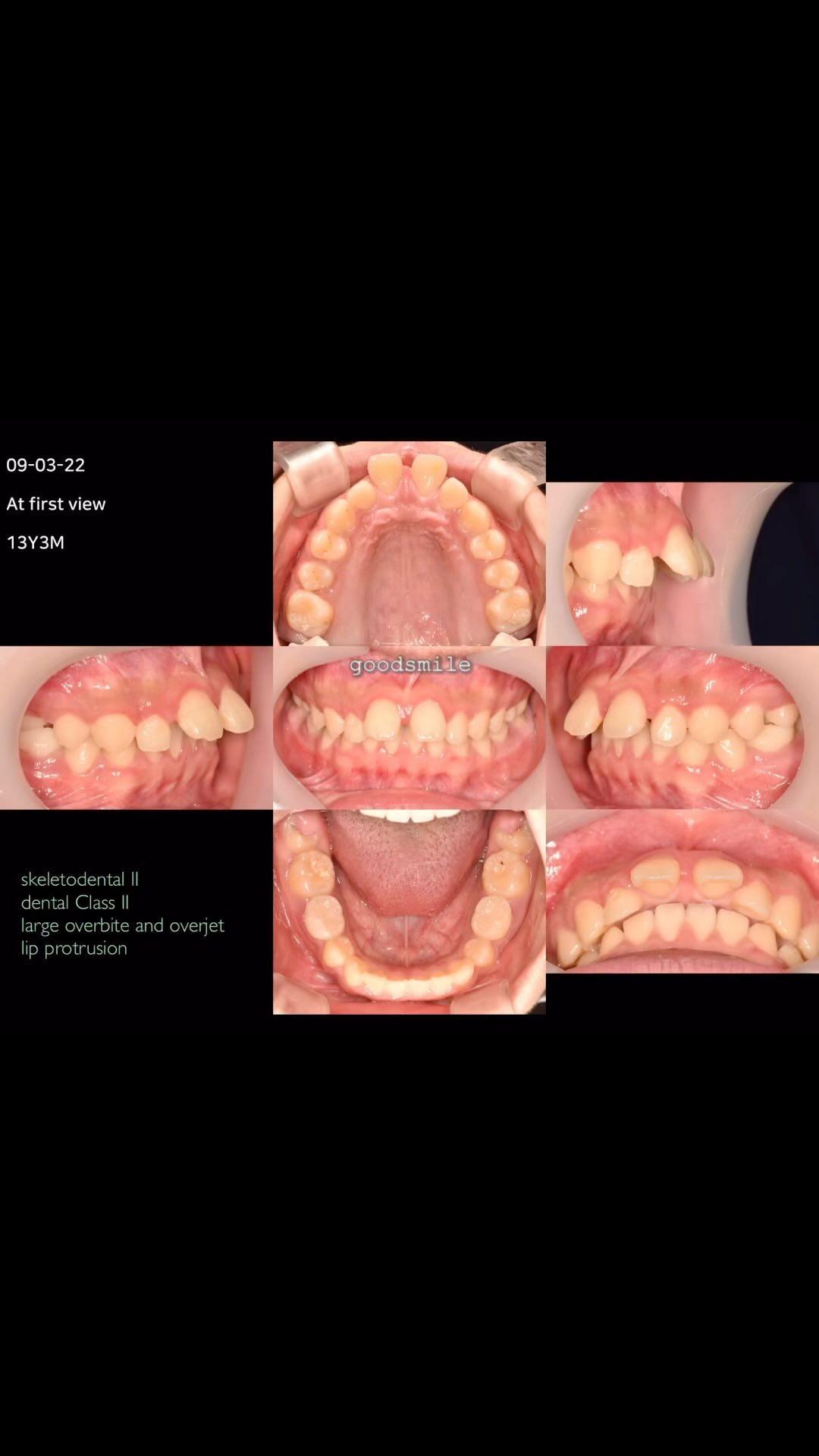 Treatment of skeletodental Class II, dental Class …