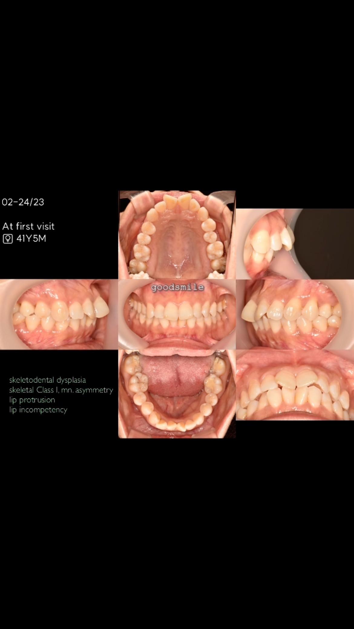 Upper total arch retraction
#blackshaqgoodsmile…