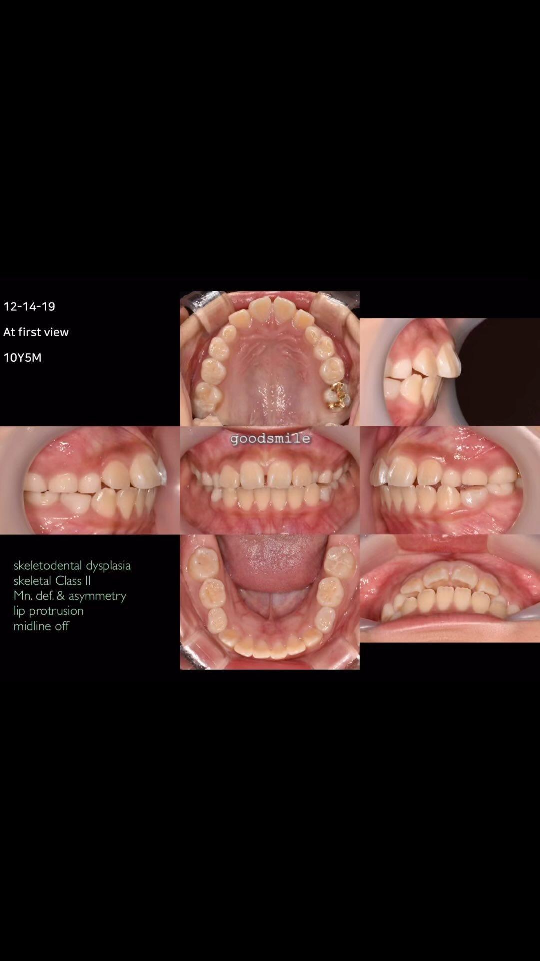 Camouflage treatment of skeletodental Class II wit…