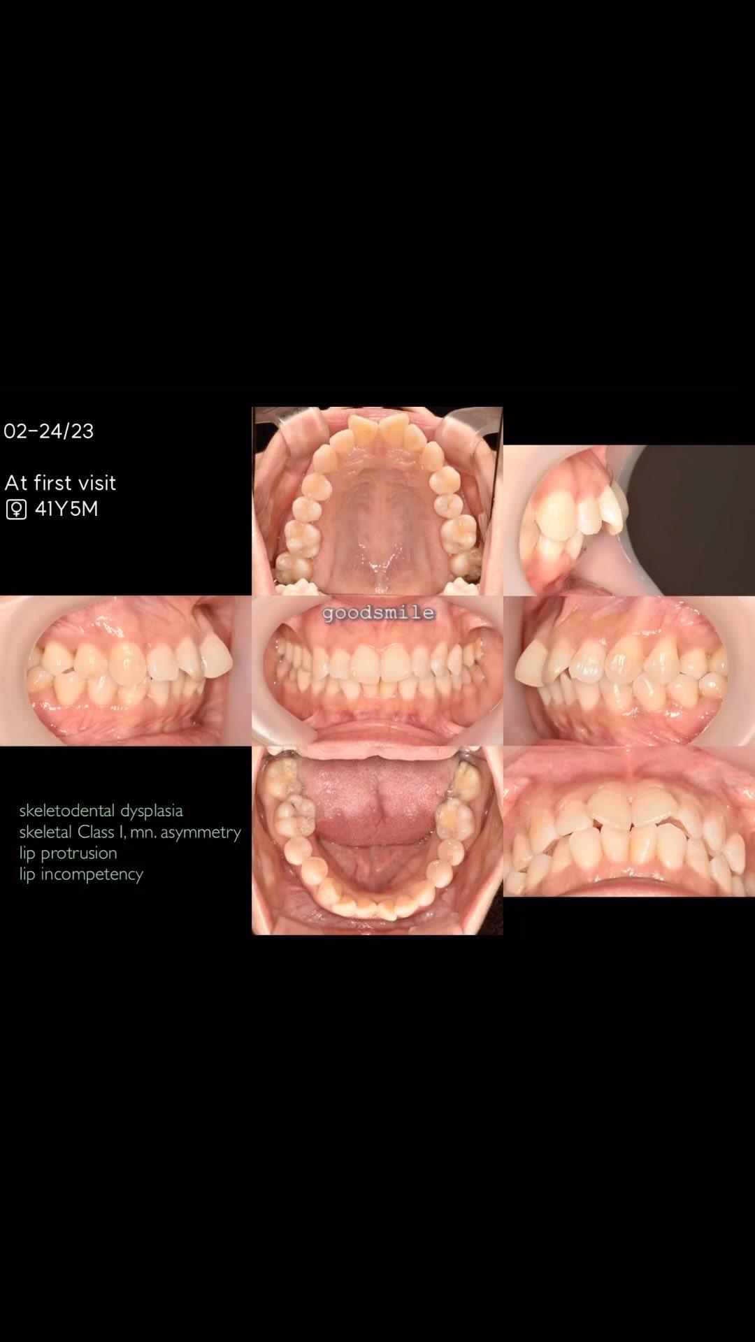 Treatment of dental Class I with severe anterior c…
