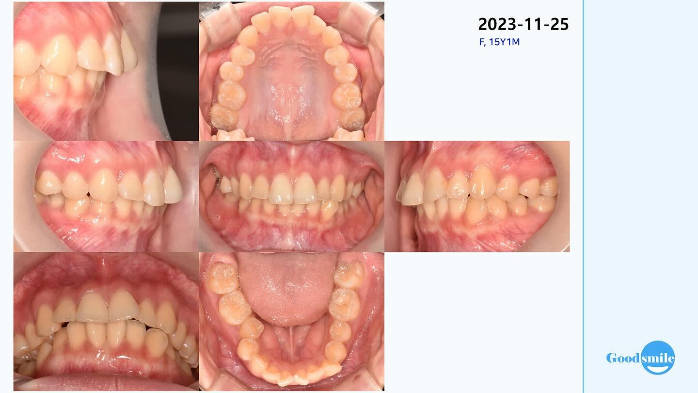 Non extraction treatment of skeletal Class II, den…