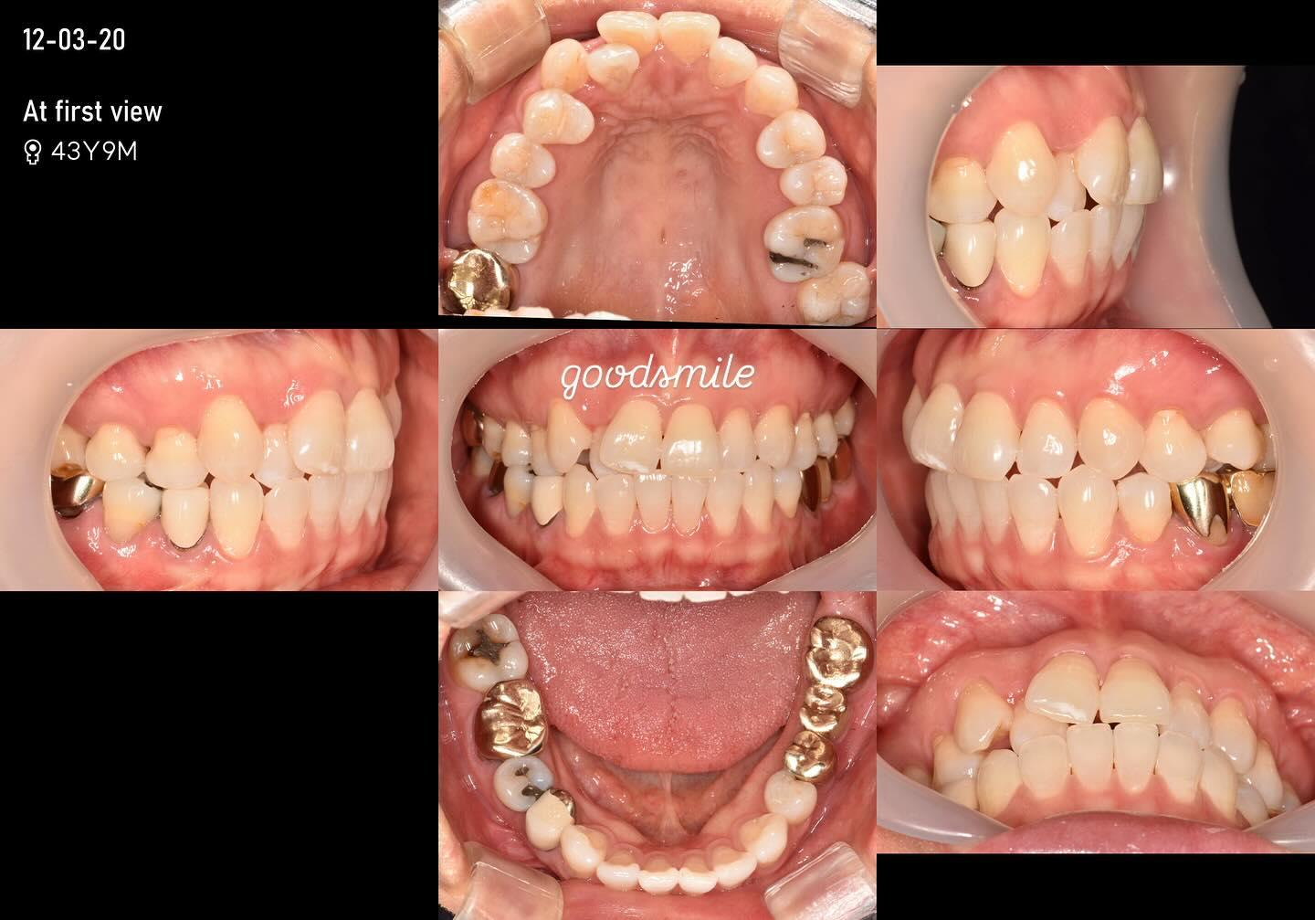 Treatment of severe crowding without extraction
#…