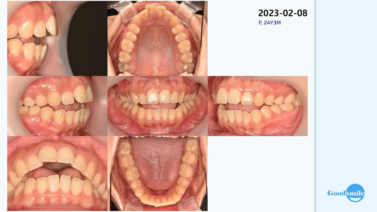 Treatment of skeletal open bite
#blackshaqgoodsmi…