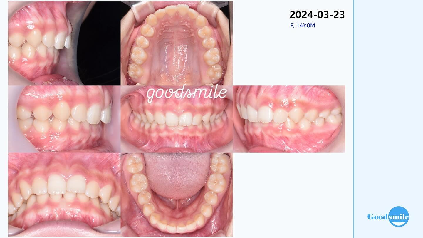 Treatment of deep overbite
#blackshaqgoodsmile…