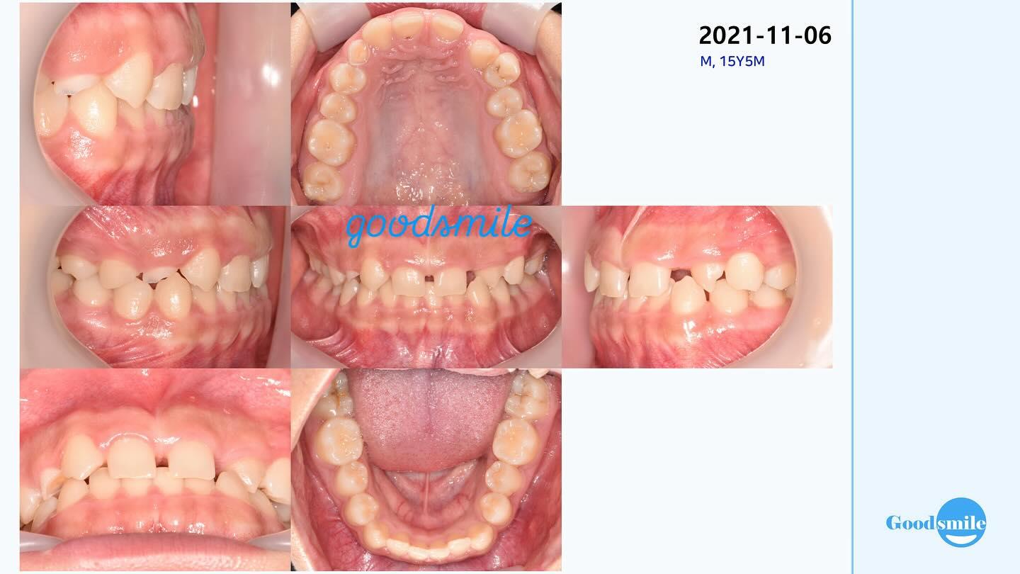I hate dental implants for adolescents
#blackshaq…