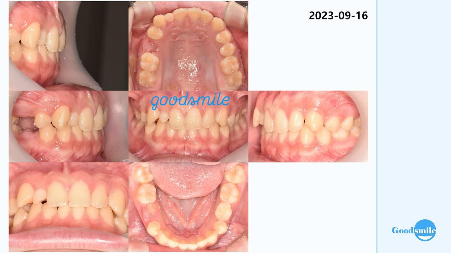 molar protraction
canine lateralization
#blackshaq…