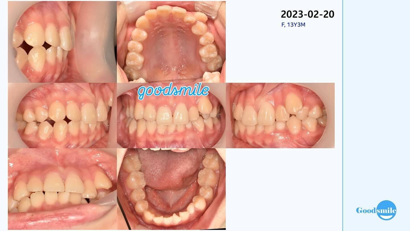 impacted lower canine
#blackshaqgoodsmile…