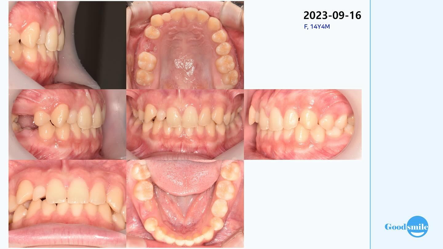 upper right lateral incisor missing
#blackshaqgood…