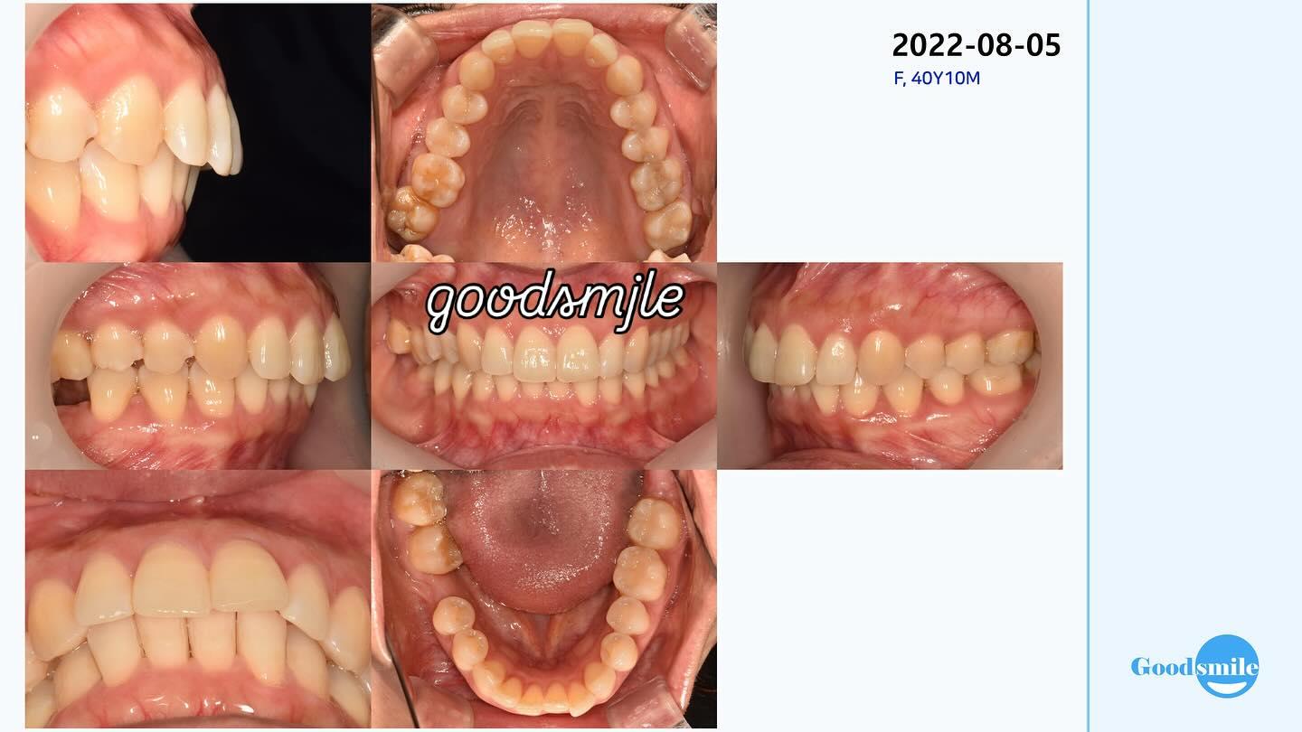 molar protraction
non ext
lip protrusion
#blacksh…