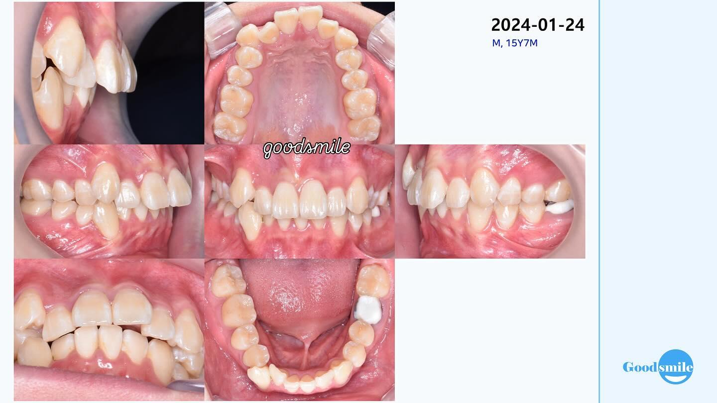 upper 4 ext
#blackshaqgoodsmile…