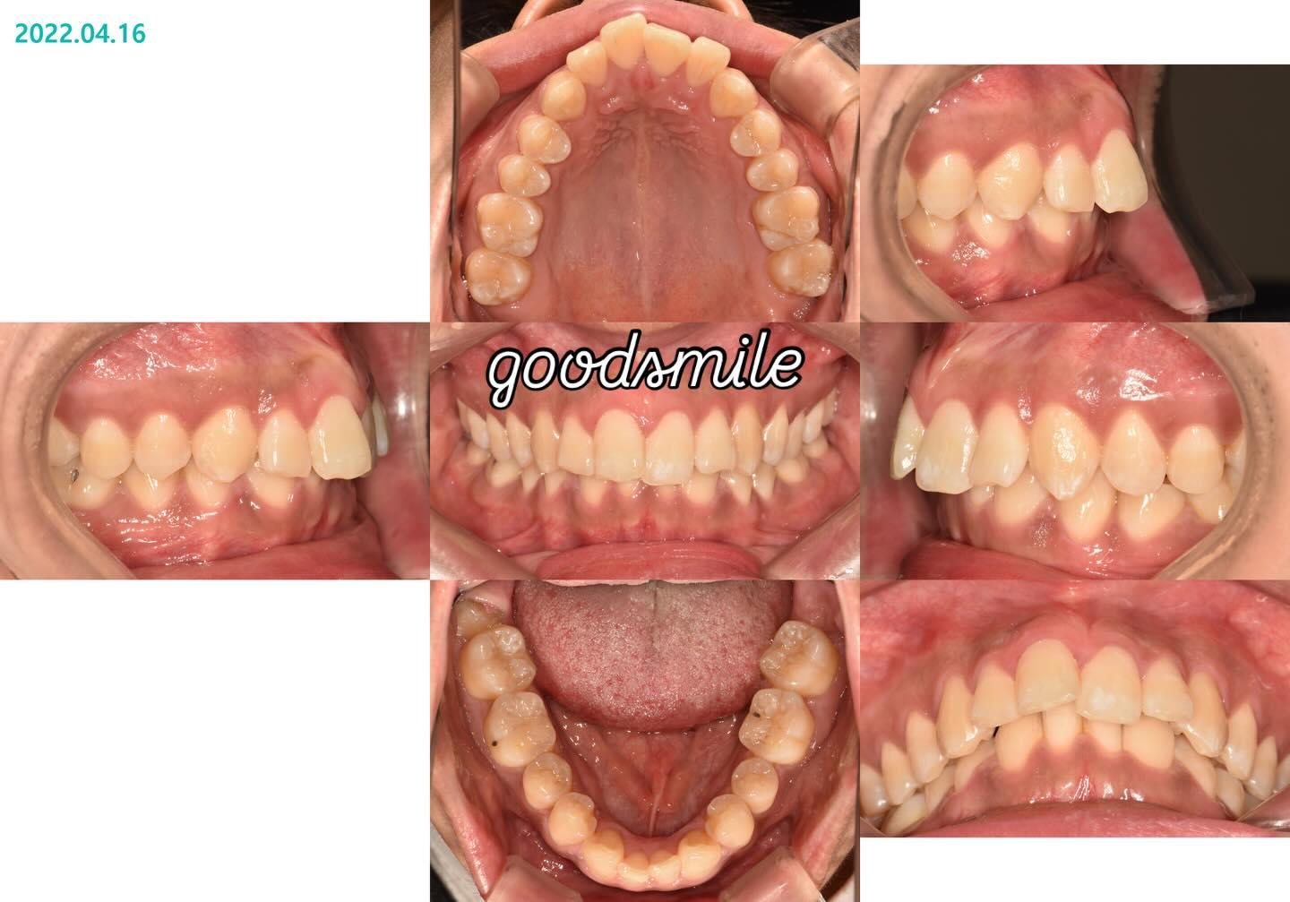 congenital missing of lower lateral incisors
#bla…