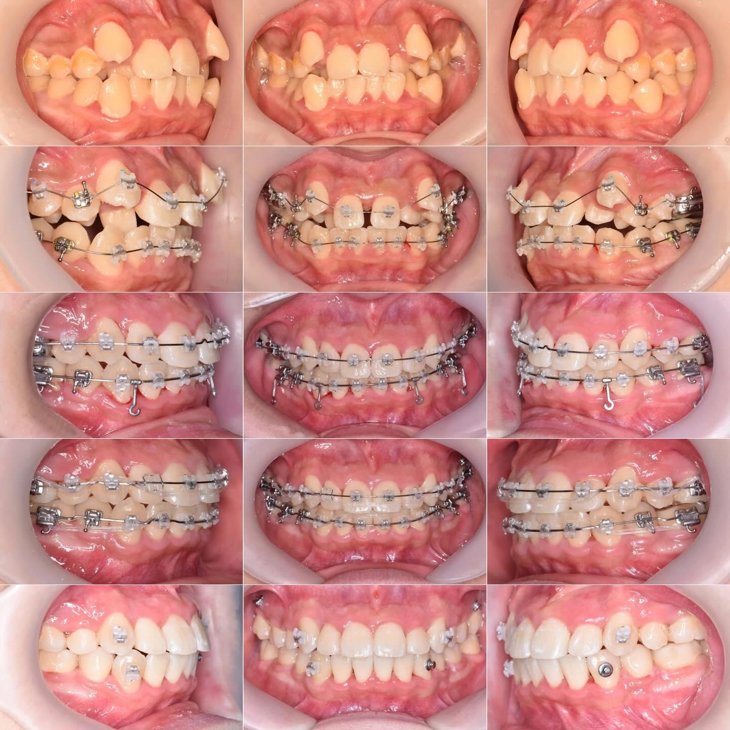 Lower left 2nd molar impaction
#blackshaqgoodsmile…