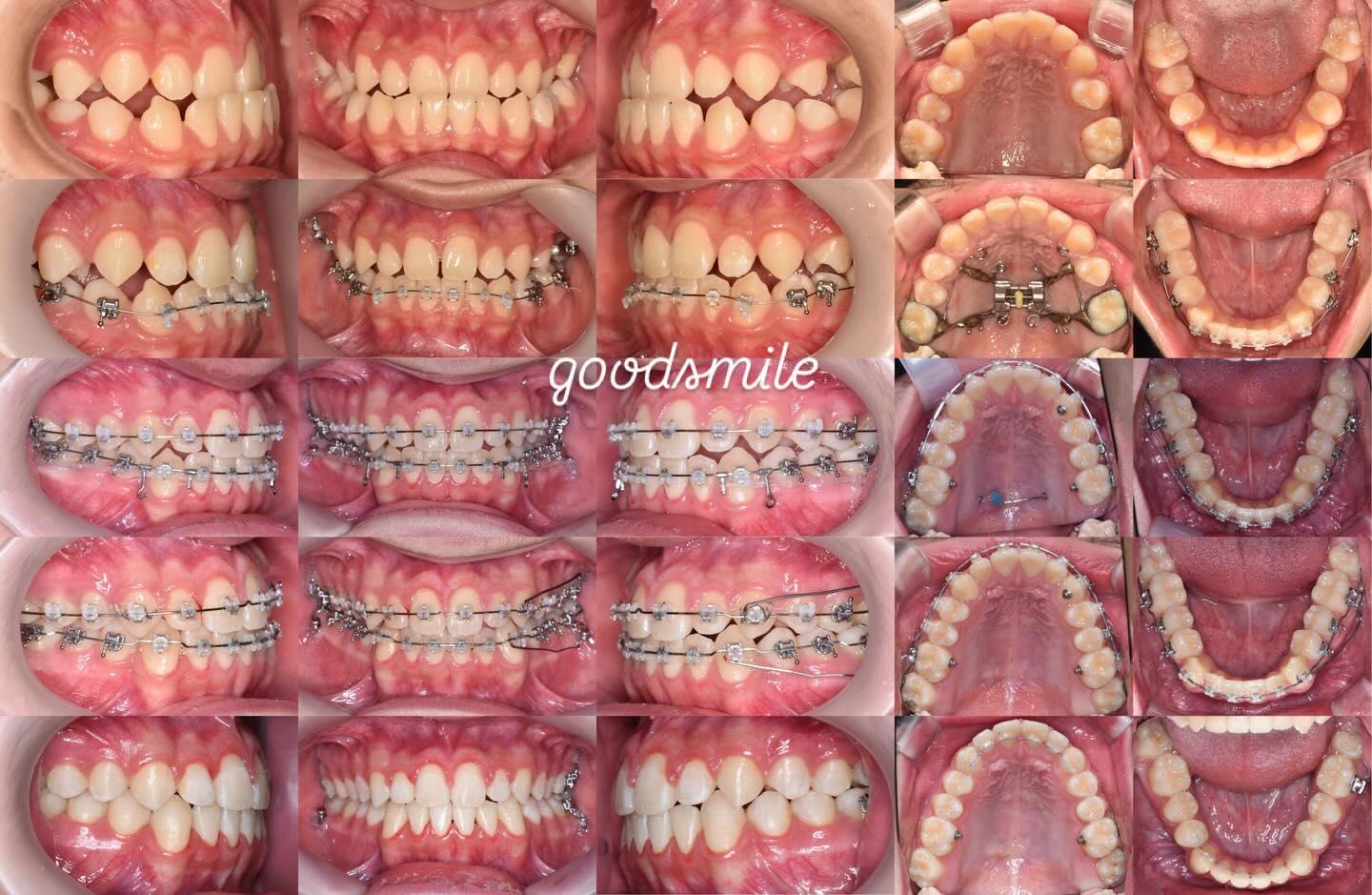 Treatment of skeletal Class III, dental Class III
…