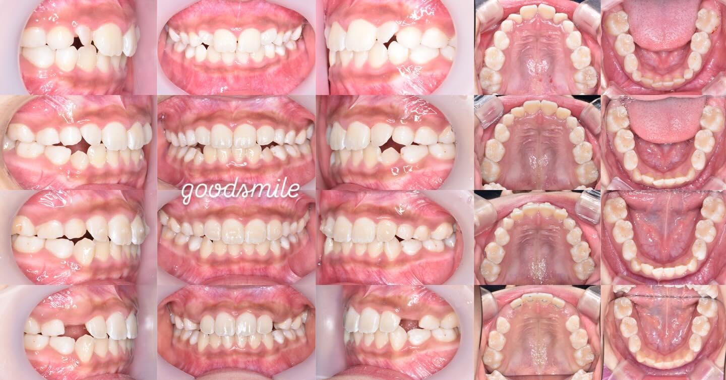Treatment with Invisalign first for my daughter
#…
