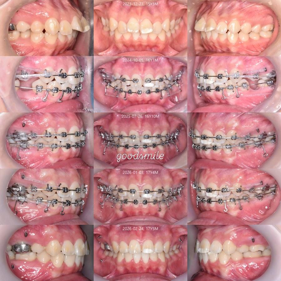 Treatment of skeletal Class II, dental Class I wit…