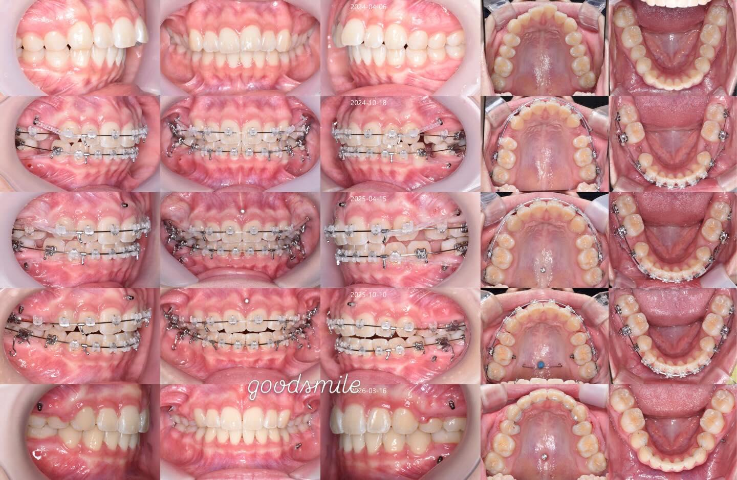 Treatment of skeletal Class II, open bite and lip …