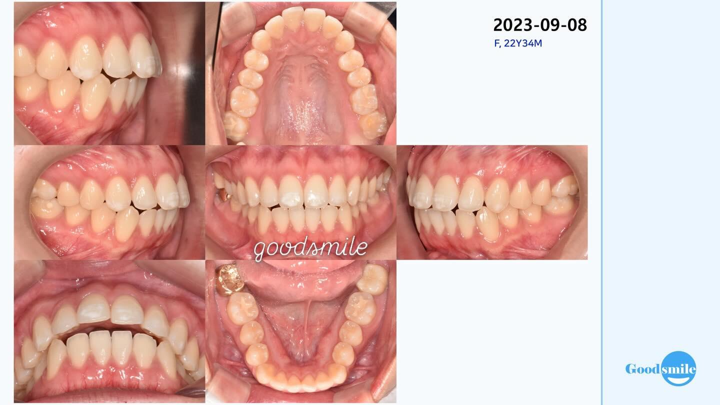 Camouflage treatment of skeletal Class II, dental …