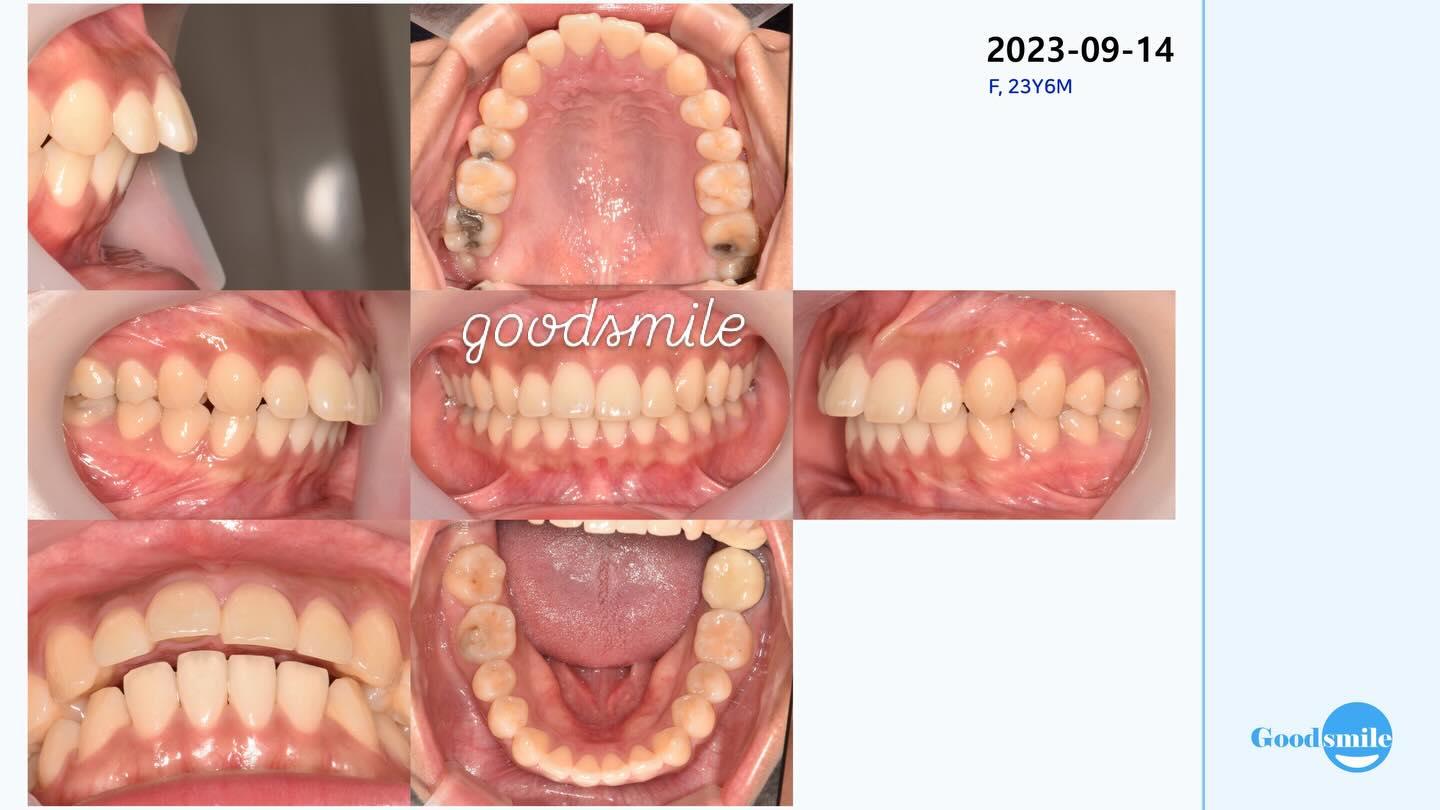 Treatment of skeletal Class II, dental Class II CR…