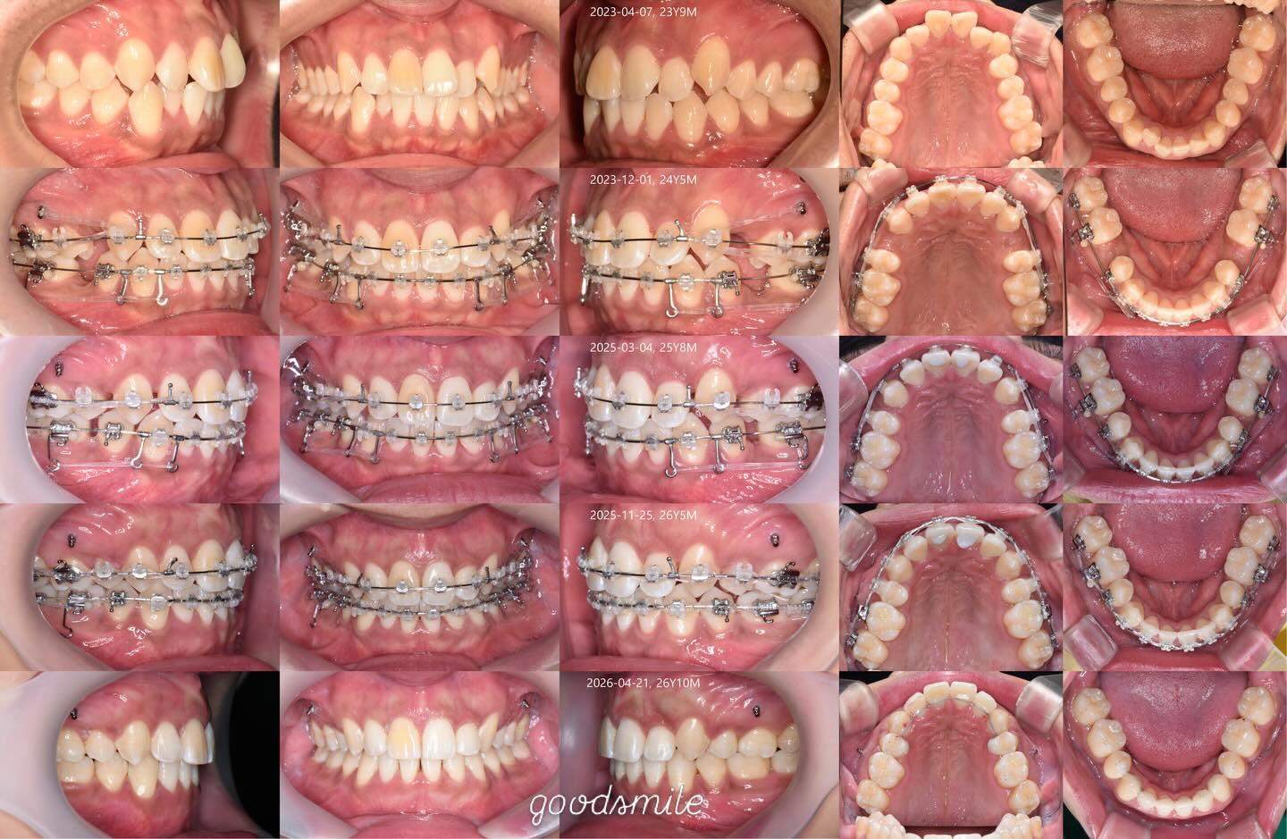 Camouflage treatment of skeletal Class II, dental …