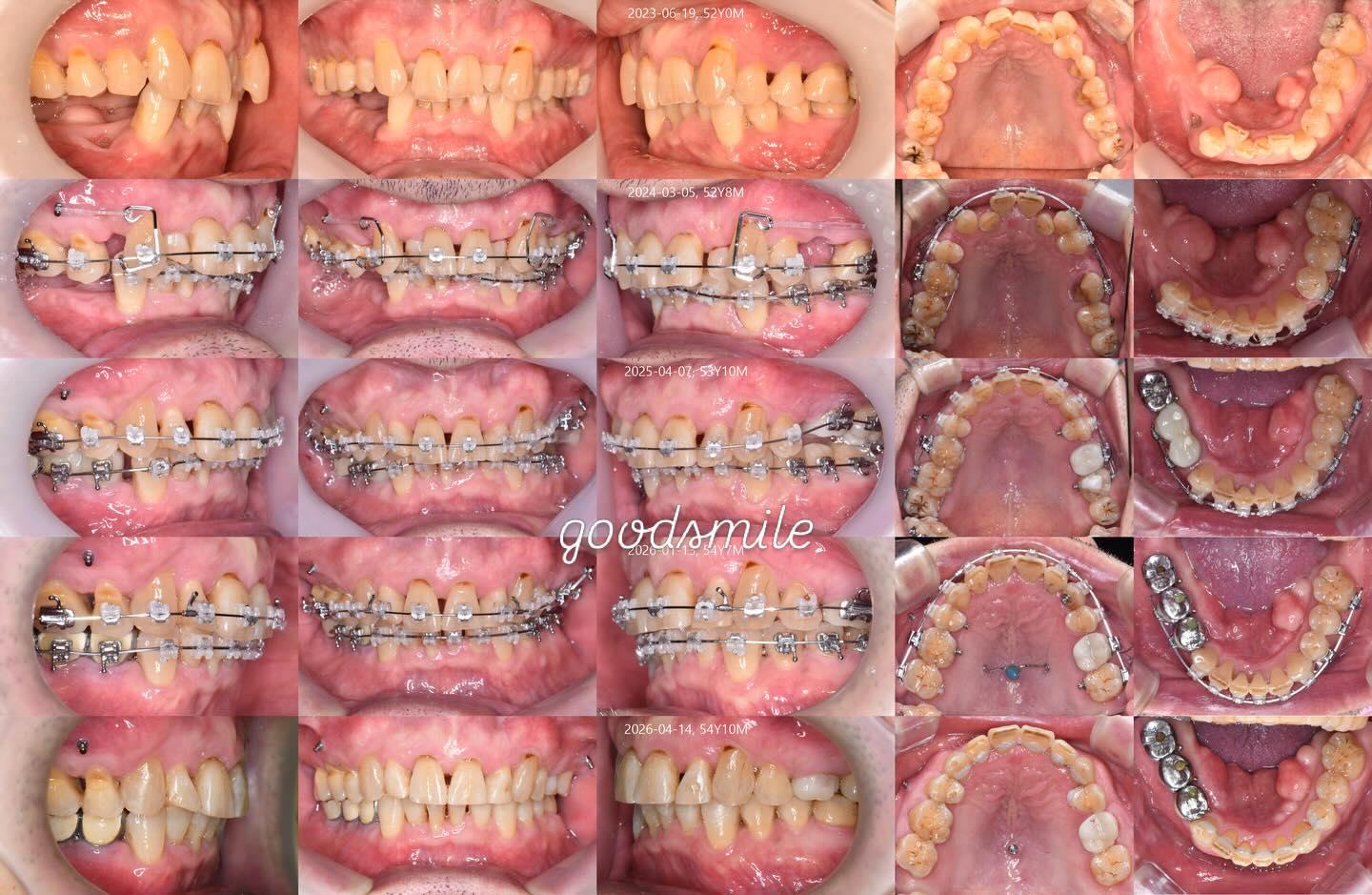 Treatment of skeletodental Class II, dental Class …