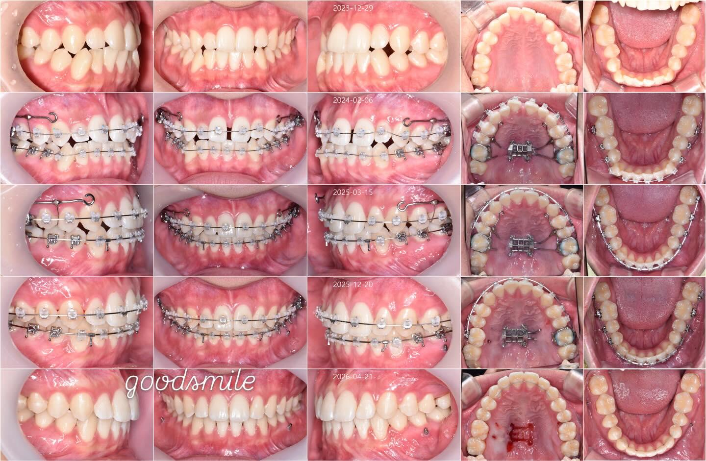 Camouflage treatment of skeletal Class III dental …