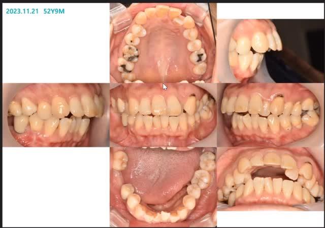 Camouflage treatment of skeletal Class II, dental …